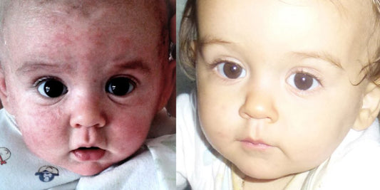 The Story Behind the Natural Cream That Soothed My Baby’s Eczema