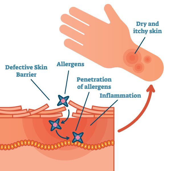 Treat Eczema Naturally-6-Avoid Allergens