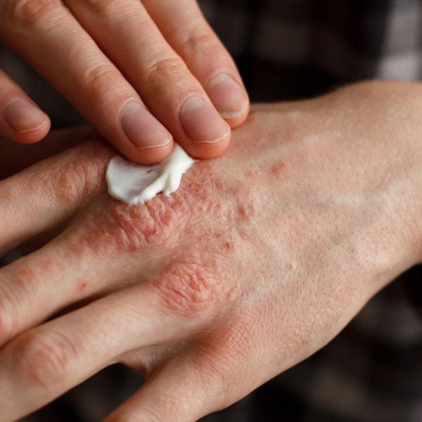 Treat Eczema Naturally-8-Natural Moisturisers